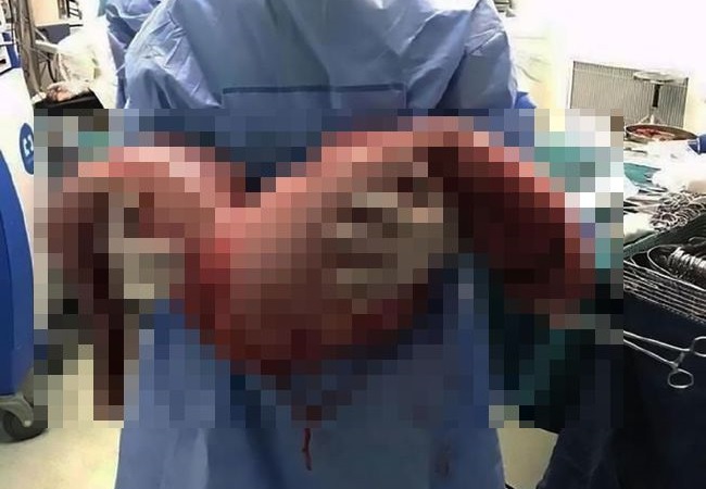 【閲覧注意】２２年間便秘してた人間のお腹を開いた結果・・・（画像）