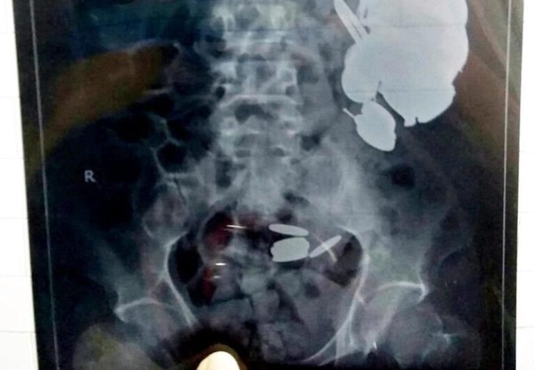 【閲覧注意】インド人の胃から出てきたものが「人間の限界を超えてる」と話題に