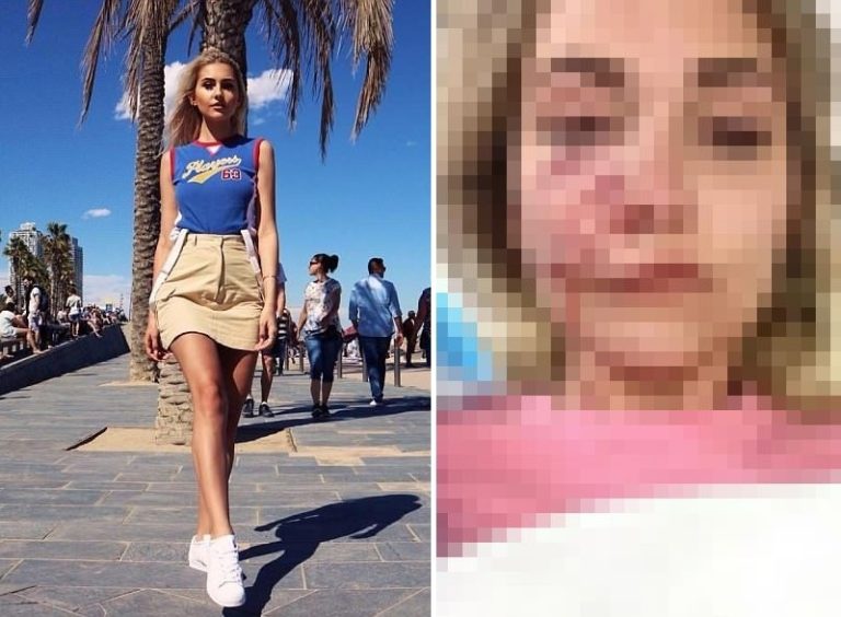 【超恐怖】顔が売りの美人モデル、犬に顔面を噛み裂かれこうなる・・・（画像あり）