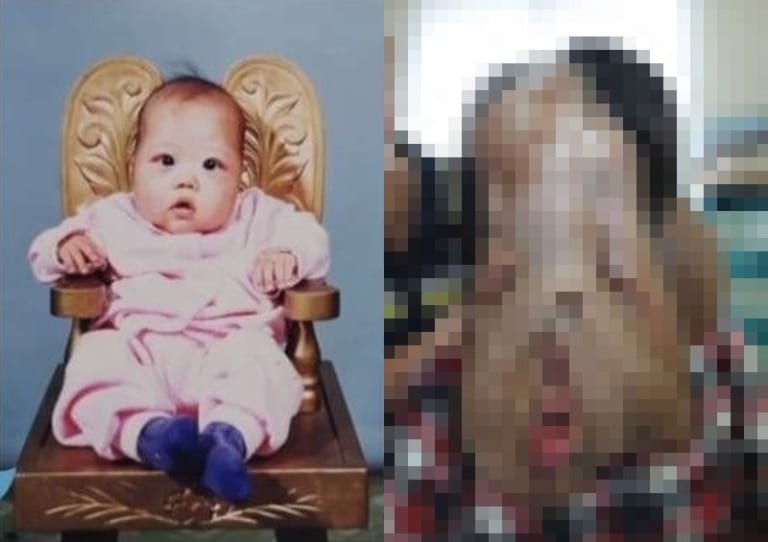 【超！閲覧注意】１歳の美少女、顔がどんどん垂れ下がっていく病気になりとんでもない事に…（画像あり）