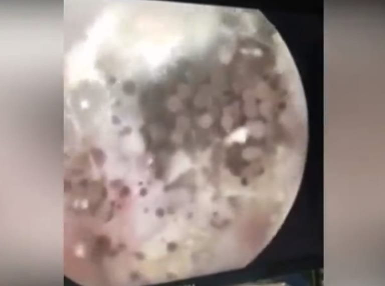 【閲覧注意】人間の耳の中で何百もの「キノコ」が成長。動画が怖すぎる