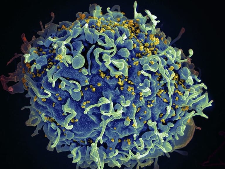 【超！閲覧注意】HIVの最終ステージ、ガチでとんでもない・・・・・