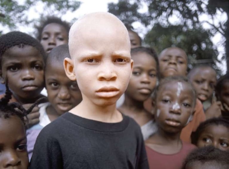 【閲覧注意】黒人だらけのアフリカで、突然変異で ”白人” が生まれたらこうなる・・・（画像あり）