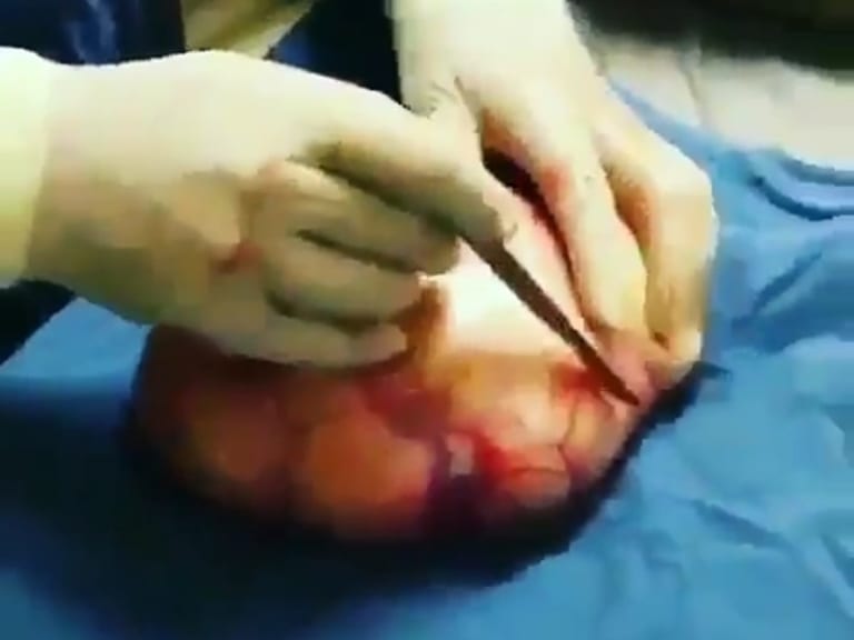 【超！閲覧注意】脳腫瘍を切ったらどうなると思う？ とんでもないぞ…（動画）
