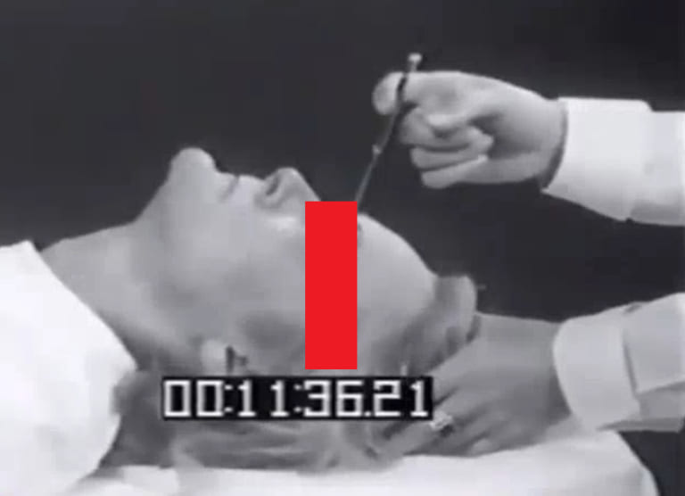 【閲覧注意】ロボトミー手術の無修正動画がめちゃくちゃ怖いんだが…