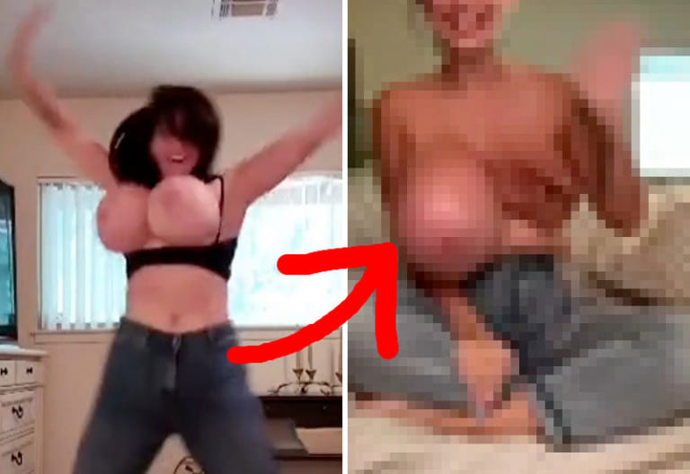 【閲覧注意】ダンスを踊る整形爆乳♀ ⇒ おっぱいが爆発しこうなる…（動画あり）