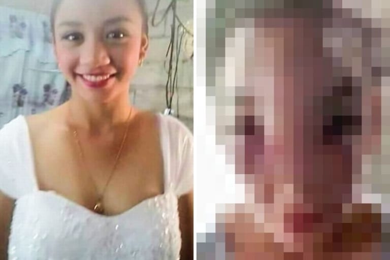 【閲覧注意】16歳の美少女「ニキビ潰そう」⇒ 原因不明の奇病を発症、顔面が崩壊（画像あり）