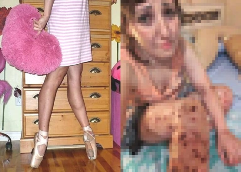【閲覧注意】「かさぶたを剥がし続ける」精神病の女が足を切断するまでの画像、怖すぎる