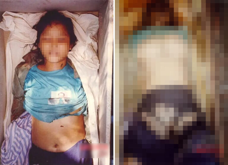 【閲覧注意】中国人さん、この10代少女を使って ”人体実験” をしてしまう… 衝撃の3枚
