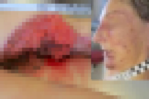 【閲覧注意】登山者を襲った史上最悪の落雷事故、即死した10歳男女・24歳女性らの画像がヤバい