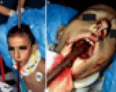 【閲覧注意】トルコの不死身の人間の画像、ガチでヤバい、ヤバすぎる