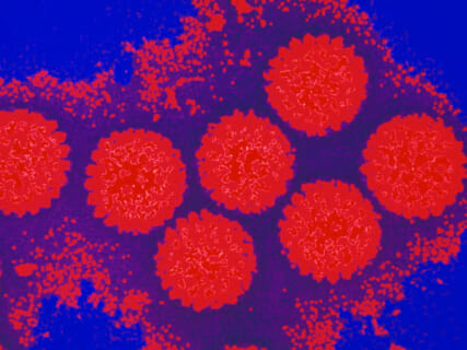 【超！閲覧注意】HIVの最終ステージ、ガチでとんでもない・・・・・