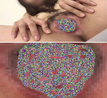 【超！閲覧注意】HIV感染者のマ○コ、やばすぎる（画像あり）