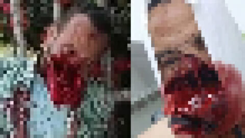 【閲覧注意】事故現場で顔面に大穴が開き精神崩壊してる男性が発見される…（動画あり）