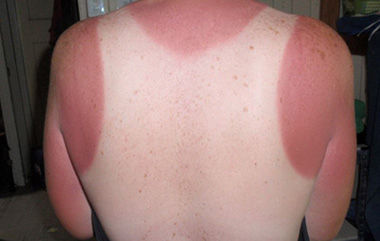 funny-sunburn-3
