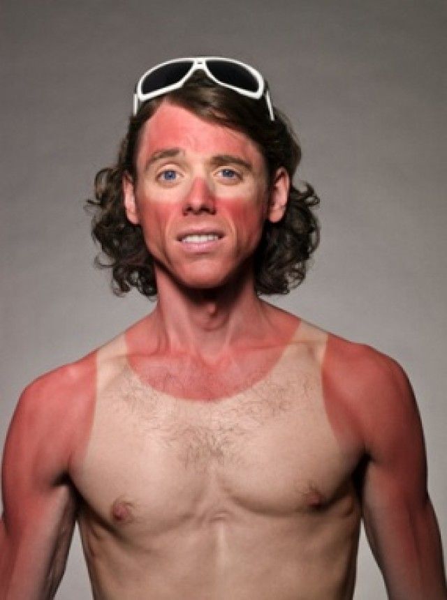 funny-sunburn-36