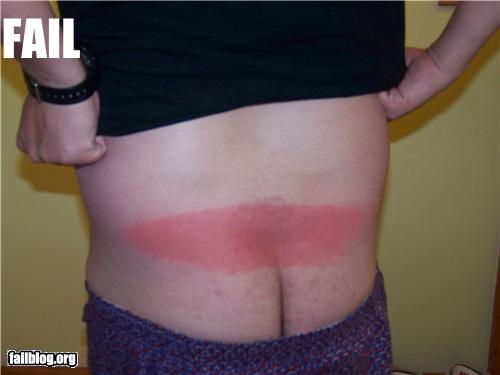 funny-sunburn-14