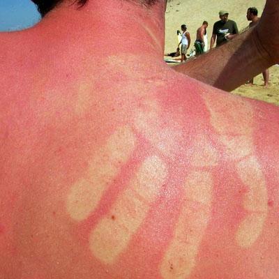 funny-sunburn-17
