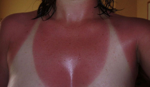 funny-sunburn-28