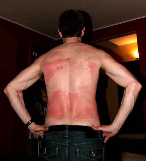 funny-sunburn-29