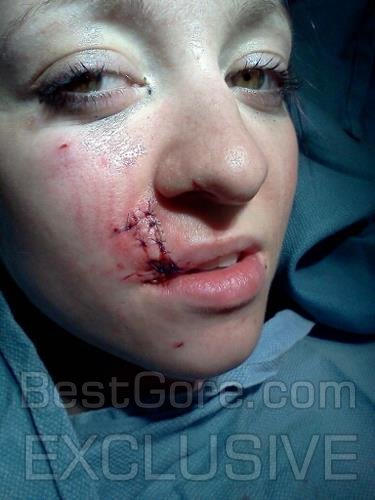 girl-bit-by-dog-in-face-best-gore-exclusive-06