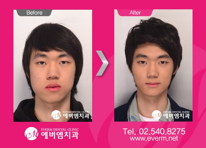 crazy_before_and_after_photos_of_korean_plastic_06