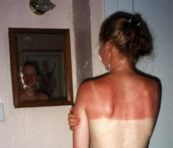 funny-sunburn-31