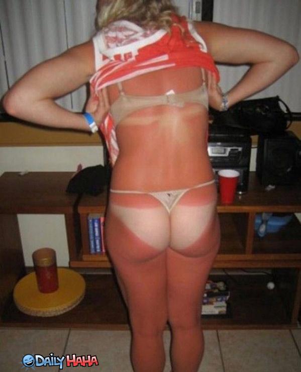 funny-sunburn-20