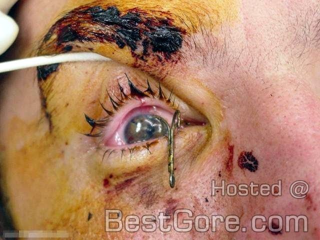 surgical-removal-fishhook-eye-05