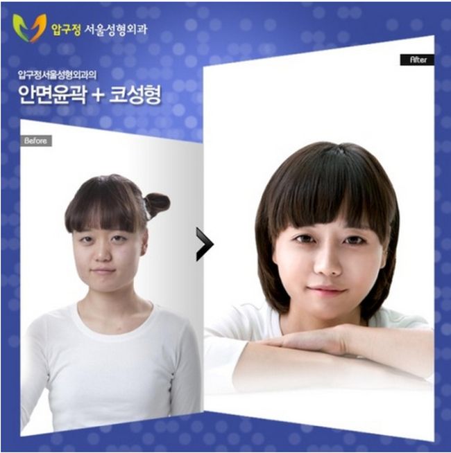 crazy_before_and_after_photos_of_korean_plastic_12