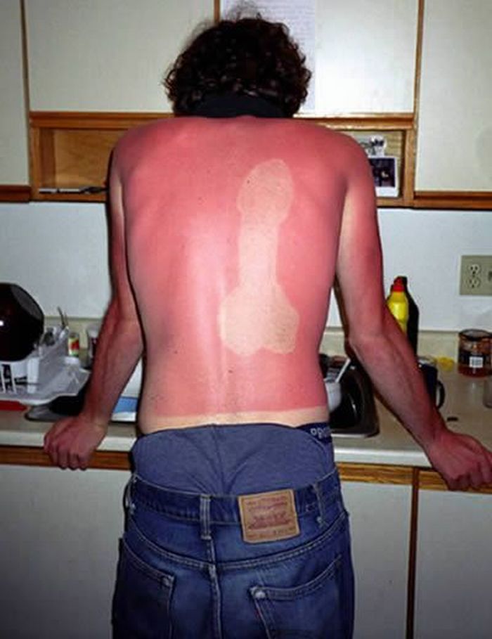 funny-sunburn-2