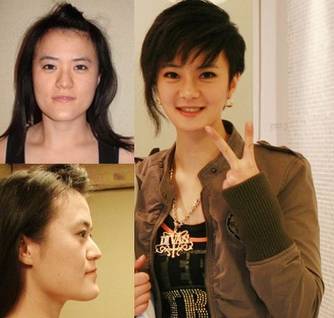 crazy_before_and_after_photos_of_korean_plastic_19