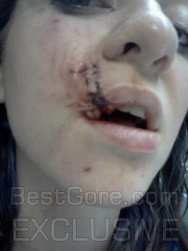 girl-bit-by-dog-in-face-best-gore-exclusive-08