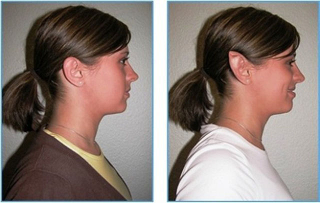 when_plastic_surgery_goes_really_wrong_640_08