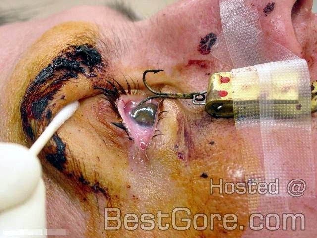 surgical-removal-fishhook-eye-07