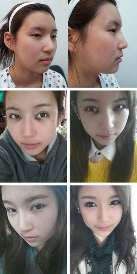 crazy_before_and_after_photos_of_korean_plastic_09