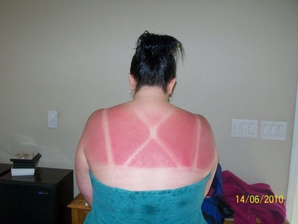funny-sunburn-9