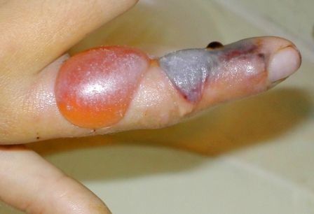 Snake bite wound on finger