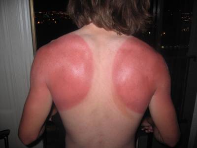 funny-sunburn-32