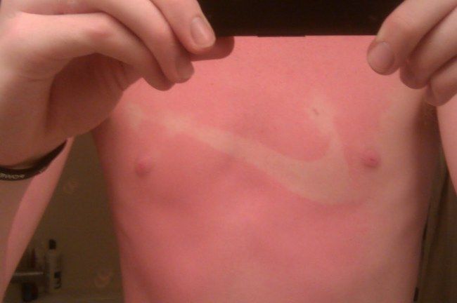 funny-sunburn-18