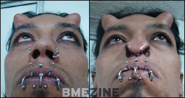 emilio-nose-reconstruction-3
