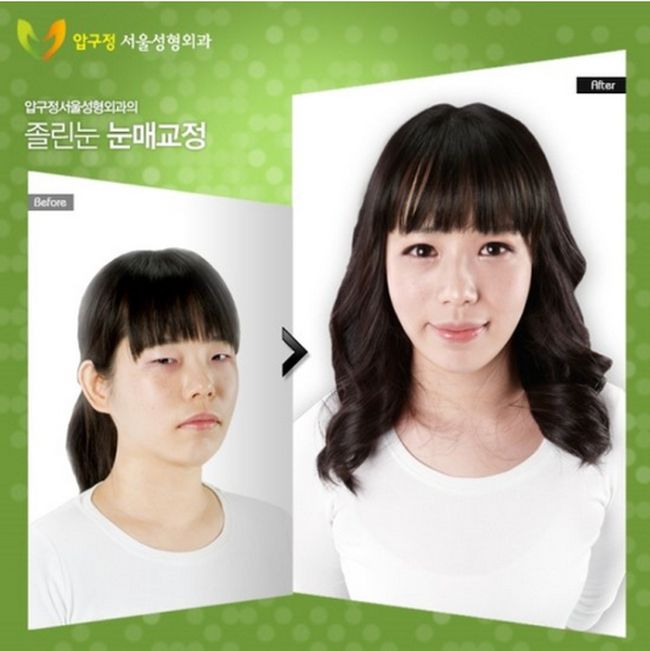 crazy_before_and_after_photos_of_korean_plastic_29