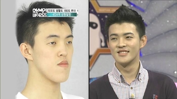 crazy_before_and_after_photos_of_korean_plastic_08