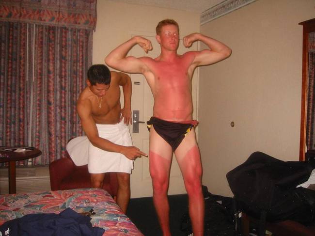 funny-sunburn-27
