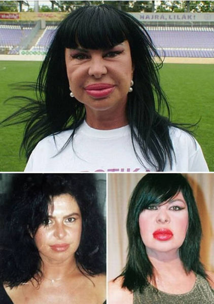 when_plastic_surgery_goes_really_wrong_640_10