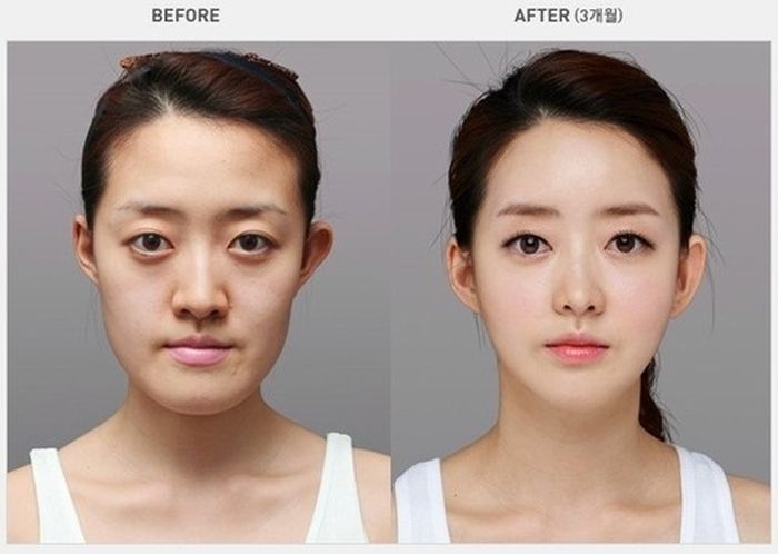 crazy_before_and_after_photos_of_korean_plastic_16