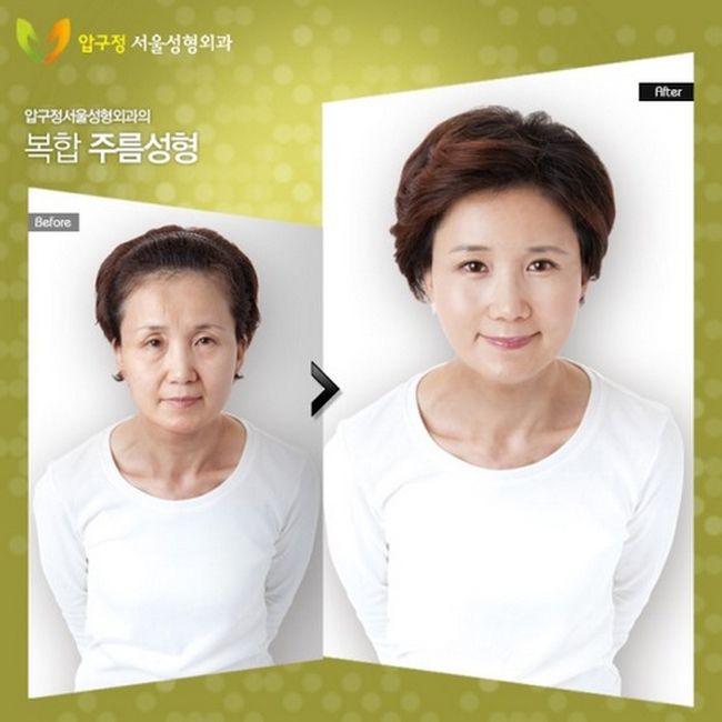 crazy_before_and_after_photos_of_korean_plastic_15
