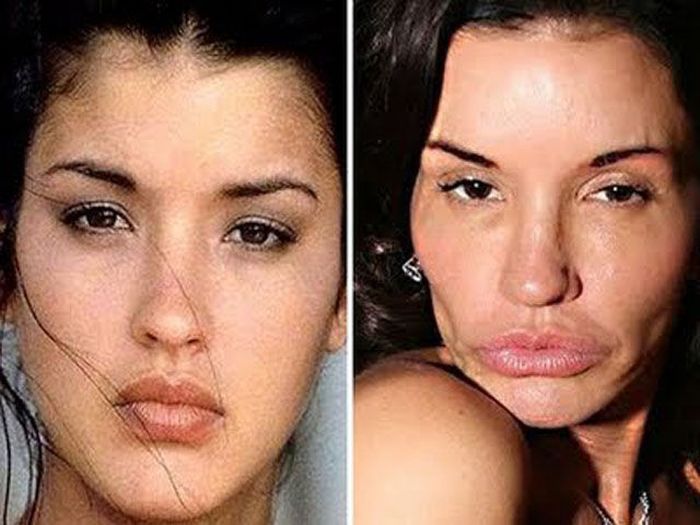 the_horrors_of_terrible_plastic_surgery_10