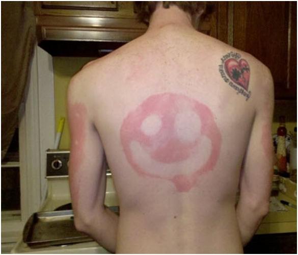 funny-sunburn-7