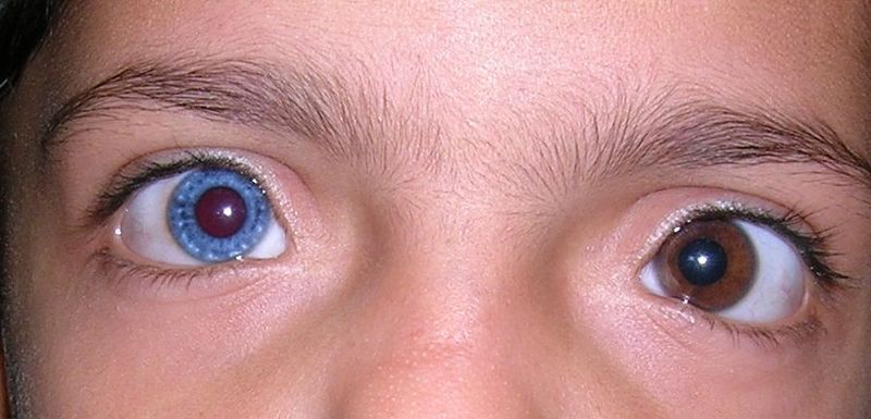 800px-Heterochromia_Iridis